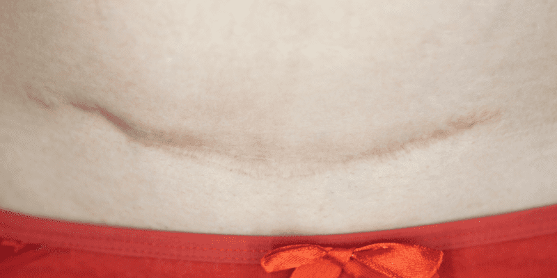 Can You Tell if Your C-Section Internal Stitches Have Ruptured? - Mama ...