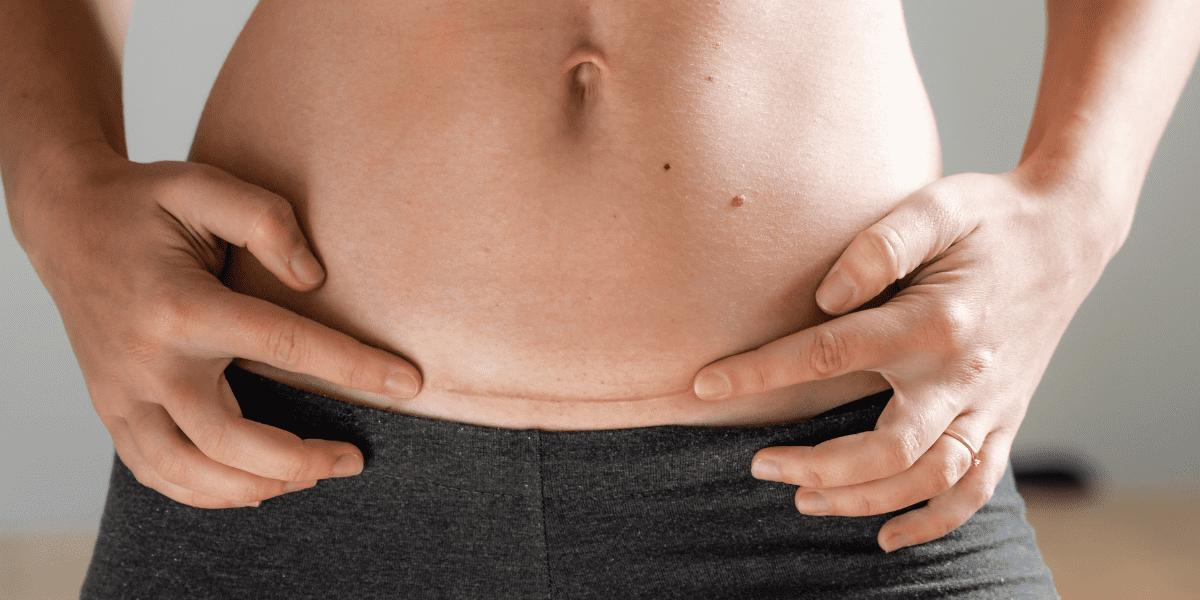 How to get rid of your hanging belly after a c-section - Mama of Five