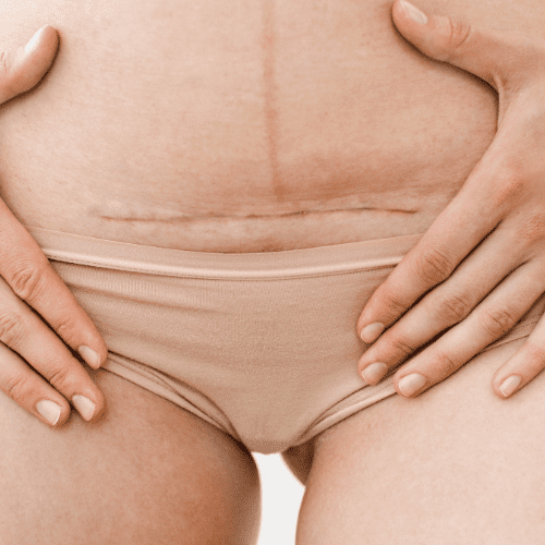 Help, my c-section incision smells!
