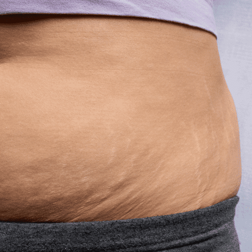 How to get rid of your hanging belly after a c-section